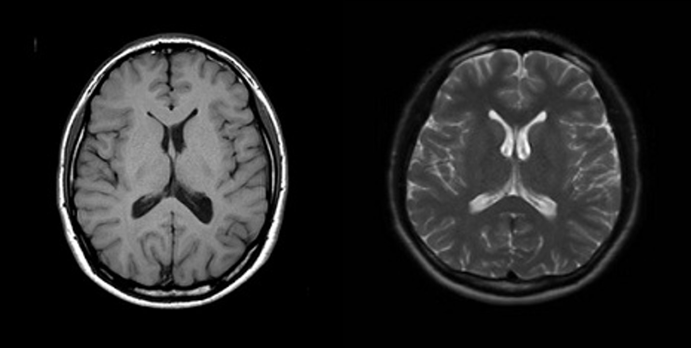 ステント mri